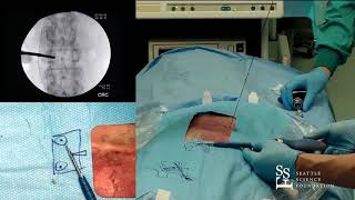 Percutaneous Screw Placement  Hyun Bae MD [upl. by Sunday]