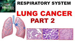 LUNG CANCER  Part 2 Morphology Clinical features [upl. by Nwadal]