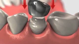 Dental Crown  Crowns And Root Canal Treatment [upl. by Eveleen]