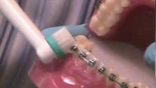 Brushing Braces with an ElectricToothbrush [upl. by Nor]