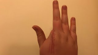 Questions About My Amputated Finger [upl. by Lenette]