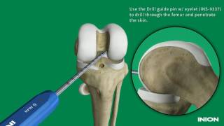 ACL Reconstruction Using the Inion Hexalon™ Screw and Inion FlipButton™ [upl. by Eanrahs101]