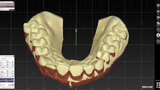 EXOCAD  Gingiva reduction guide design [upl. by Aronal]