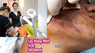 Acne treatment reputation effective at Hien Van Spa383I Lưu hoàng Minhpart4 [upl. by Tansey927]