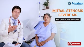 MRCP PACES Clinical Case  Cardiology  Severe Mitral Stenosis MS [upl. by Anotal]