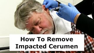 Removing Impacted Cerumen from a Patients Ear [upl. by Namien]