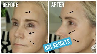 BBL LIGHT TREATMENT BEFORE AND AFTER  MY BBL LASER TREATMENT FOR BROWN SPOTS amp SPIDER VEINS [upl. by Shelby933]