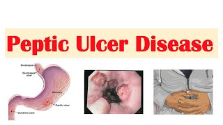 Peptic Ulcer Disease Gastric vs Duodenal Ulcers  Causes Symptoms Diagnosis Treatment [upl. by Balliett]