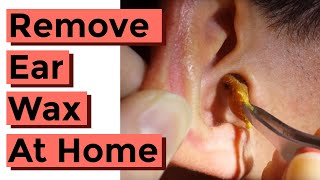 How To Remove Ear Wax at Home aka Impacted Cerumen [upl. by Lorre76]