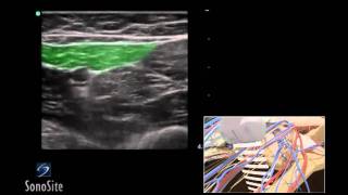 How toperform a ring block digital block [upl. by Nawor]