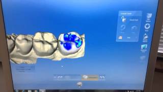 CEREC Crowns A OneVisit Procedure  Dr Brian Mills [upl. by Wivina187]