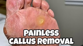 CALLUS REMOVAL FROM FEET PAINLESS PROCEDURE [upl. by Sheeran]