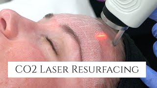 CO2 Laser Facial Rejuvenation  Fix Fine Lines and Wrinkles  Fix Sun Damage  Fix Stretch Marks [upl. by Darline]