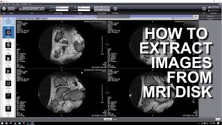 HOW TO EXTRACT IMAGES FROM A MRI DICOM DISK [upl. by Lsil]