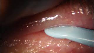 How to clean the eyelids for blepharitis treatment [upl. by Geof]