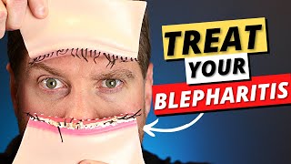 What is blepharitis Is it serious [upl. by Temple]