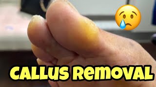 EXTREMELY SATISFYING CALLUS REMOVAL FROM THE FOOT [upl. by Zashin]