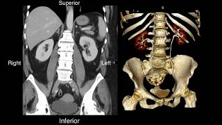 Carotid Artery Stenosis  Vascular Surgery [upl. by Netnert]