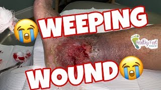 Weeping Wound [upl. by Laurin]