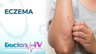 Eczema Symptoms Causes and Treatment  Doctors on TV [upl. by Tania]