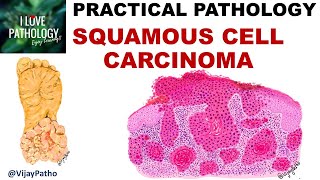 SQUAMOUS CELL CARCINOMA Clinical features amp Morphology Premalignant lesions [upl. by Ardeid]