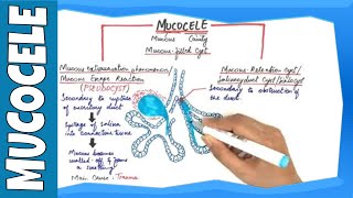 Mucocele  Types Clinical Features Histopathalogic features amp Treatment [upl. by Ahsekin400]