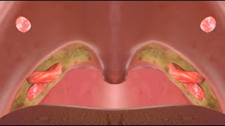 4 Ways to Treat Velopharyngeal Insufficiency VPI [upl. by Rudolfo]