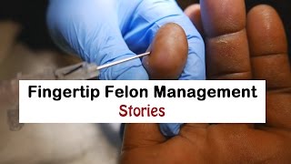 Fingertip Felon Management Stories [upl. by Mulac]