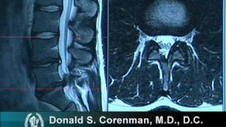 How to Read a MRI of a Lumbar Herniated Disc  Lower Back Pain  Colorado Spine Surgeon [upl. by Eelime174]