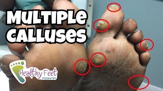 Multiple Calluses on Feet [upl. by Quint]