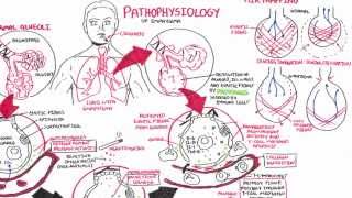 Emphysema  Pathophysiology COPD [upl. by Nnainot]