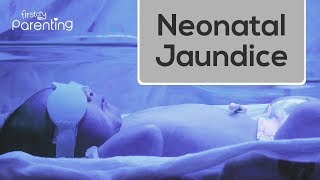 Neonatal Jaundice  Causes Symptoms and Treatment [upl. by Odrareg]