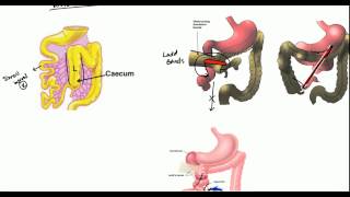 Gut Malrotation Nonrotation and Volvulus for USMLE [upl. by Janel]