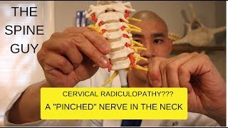 CERVICAL STENOSIS RADICULOPATHY PART 1  SYMPTOMS IMAGING AND PATIENT EXAM [upl. by Orferd]