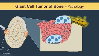 Optimal Patient Selection for Denosumab in Giant Cell Tumor of Bone [upl. by Agueda]