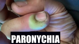 Paronychia  Katuruturu  home remedy and treatment [upl. by Nosliw]