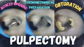 Pulpectomy  access opening  chemomechanical preparation  obturation  pulpectomy procedure 84 [upl. by Thomsen]