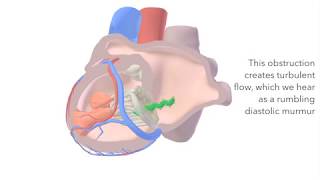 Mitral Stenosis  sound amp animation [upl. by Orbadiah]