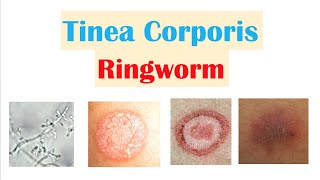 Ringworm Tinea Corporis  Causes Risk Factors Signs amp Symptoms Diagnosis and Treatment [upl. by Heid206]