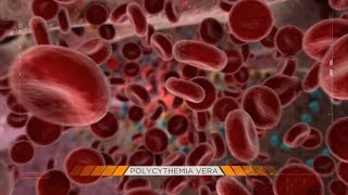 Living with A Rare Blood Cancer Polycythemia Vera [upl. by Shana]