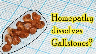 Can homeopathic medicine dissolve gallstones  Dr Sanjay Panicker [upl. by Alister]