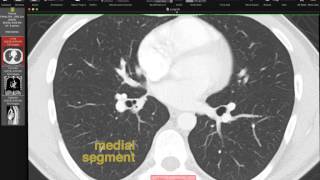 Lobar and Segmental Lung Anatomy on CT [upl. by Gyasi]