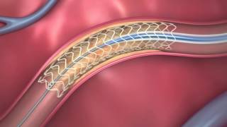 Technology Helps Improve Common Coronary Angioplasty Procedure [upl. by Divaj]