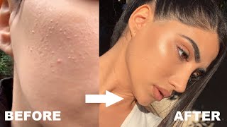 HOW I GOT RID OF STUBBORN BUMPS AND TEXTURED SKIN [upl. by Nrubliw523]