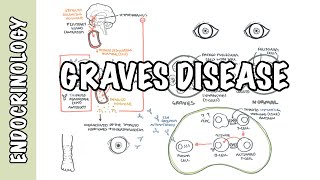 Graves Disease  Overview causes pathophysiology investigations and treatment [upl. by Leanna]