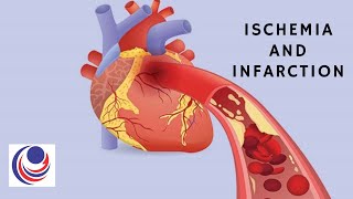 Ischemia and Infarction The difference and Similarities [upl. by Colby]