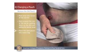 ColostomyIleostomy Changing a Pouch [upl. by Accber]