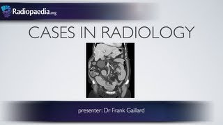 Cases in Radiology Episode 2 abdomen CT [upl. by Nayt]