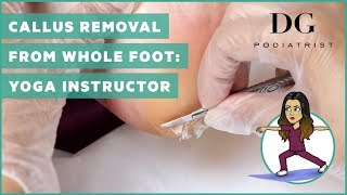 Callus Removal from whole foot Yoga Instructor [upl. by Lanaj499]