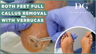 Callus removal from feet both feet and three verruca plantar warts treatment [upl. by Eerac]